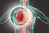 Red hepatisation of lobar pneumonia, conceptual illustration