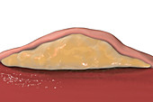 Lipoma, cross-section, illustration