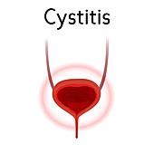 Cystitis, illustration