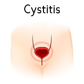 Cystitis, illustration