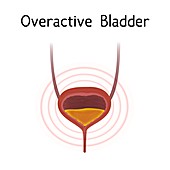 Overactive bladder, illustration