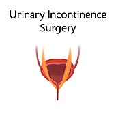 Urinary incontinence surgery, illustration