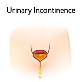 Urinary incontinence, illustration