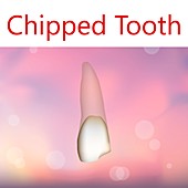 Chipped tooth, illustration