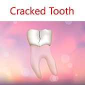 Cracked tooth, illustration