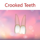 Crooked teeth, illustration
