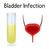 Bladder infection, illustration