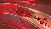 Arteriosclerosis, illustration