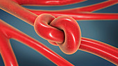 Vascular disease, conceptual illustration