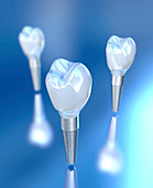 Dental implants, illustration
