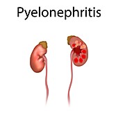 Pyelonephritis, illustration