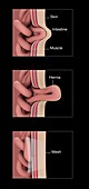 Hernia anatomy and repair, illustration