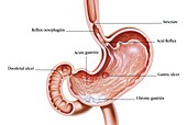 Gastric and duodenal ulcers and acid reflux, illustration