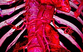 Aortic aneurysms, 3D CT scan