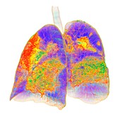 Lungs affected by Covid-19 atypical pneumonia, 3d CT scan