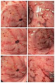 Stomach bleeding, endoscopy images