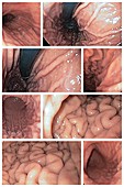 Normal stomach, endoscopy images