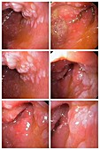 Intestinal metaplasia, endoscopy images