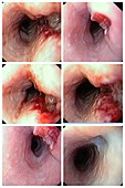 Oesophageal tuberculosis, endoscopy images
