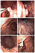 Colorectal polyps, endoscopy images