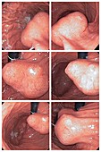 Gastrointestinal stromal tumours, endoscopy images