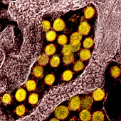 Covid-19 coronavirus sample, TEM