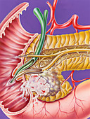 Pancreatic cancer, illustration