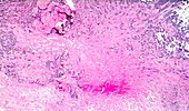 Liver cirrhosis causing breast cancer, light micrograph