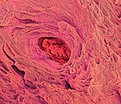 Blocked sweat gland, SEM