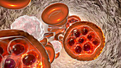 Malaria infection, illustration