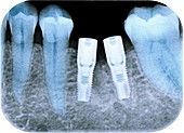 Dental implants following tooth extraction, X-ray