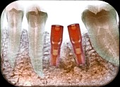 Dental implants following tooth extraction, X-ray
