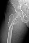 Hip fracture, X-ray