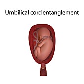 Umbilical cord entanglement, illustration