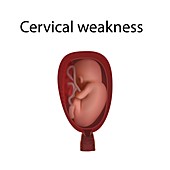 Cervical weakness, illustration