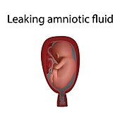 Leaking amniotic fluid, illustration