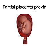 Partial placenta previa, illustration