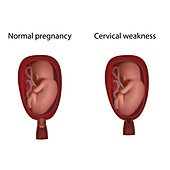 Cervical weakness and normal pregnancy, illustration