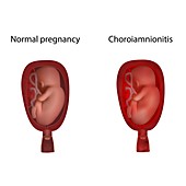 Choroiamnionitis and normal pregnancy, illustration