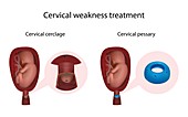 Cervical weakness, cerclage and pessary, illustration