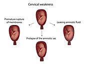 Cervical weakness complications, illustration