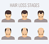 Male-pattern baldness stages, illustration