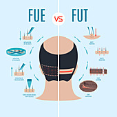 FUE and FUT hair loss treatments comparison, illustration