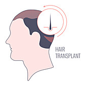 Hair transplantation in men, conceptual illustration