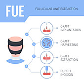 FUE hair transplantation in men, illustration