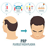 Stages of PRP procedure in men, illustration