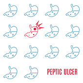 Peptic ulcer stomach, conceptual illustration