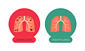 Lungs with tuberculosis and healthy lungs, illustration