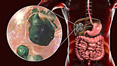 Hydatid disease in liver, alveolar echinococcosis, illustrat