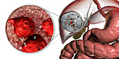 Hydatid disease in liver, cystic echinococcosis, illustratio